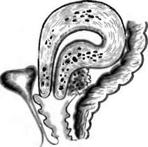 позашийковий ендометріоз