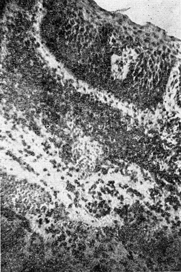 хронічний трихомонадний уретрит