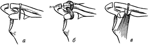 техніка операції при ушкодженні акроміально-ключичного зчленування