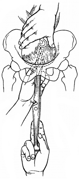 перфорація голівки плоду базиотрибом Тарнье