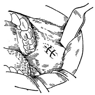 після видалення фіброми накладені шви на рану