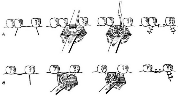 етапи операції видалення коренів зубів