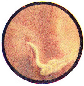 виділення з гирла сечоводу густого гною