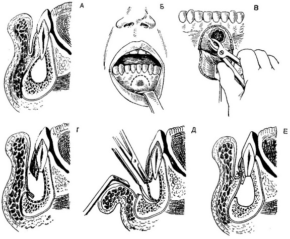 схема операції при кісті щелепи