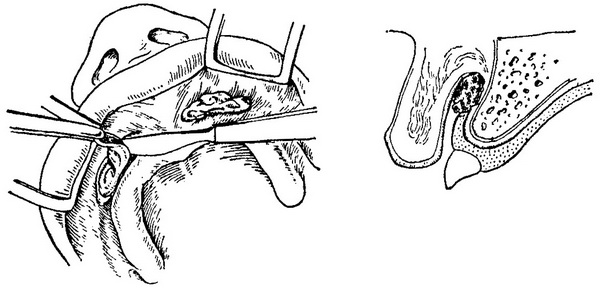 висічення дольчатой фіброми