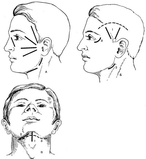 напрямок розрізів при флегмонах і абсцесах