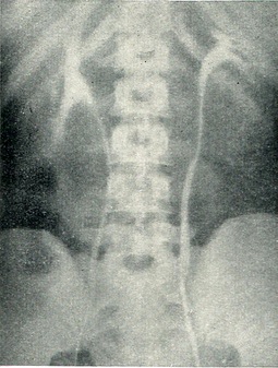 двостороння пієлограма при правосторонньому нижньому паранефриті