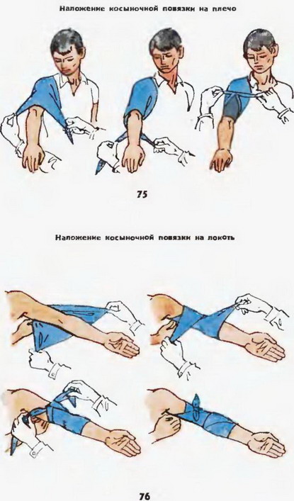 накладення косыночной пов'язки на плече і лікоть