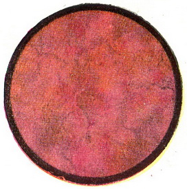 гострий цистит цистоскопія