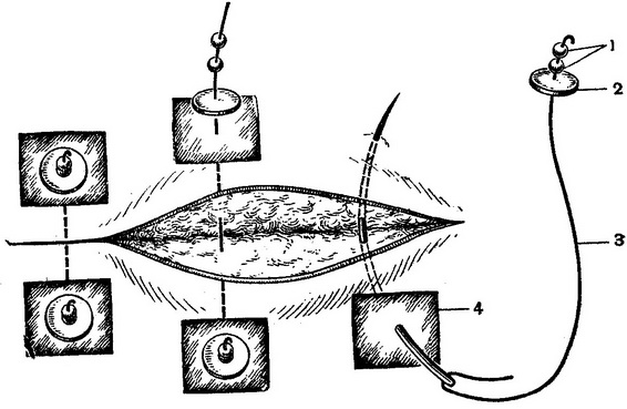 пластинковий шов