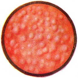 фолікулярний цистит