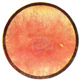 проста виразка сечового міхура