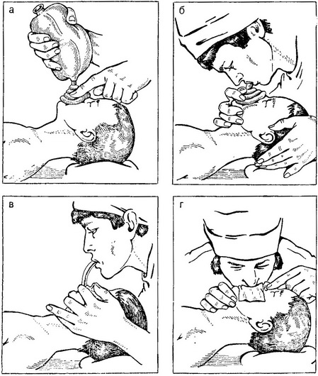 методики штучного дихання