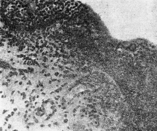 підгострий трихомонадний уретрит