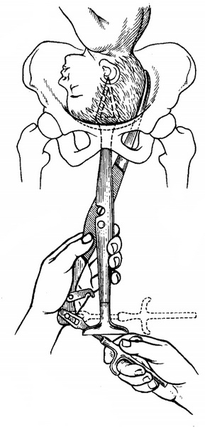 введення першої бранші базиотриба Тарнье