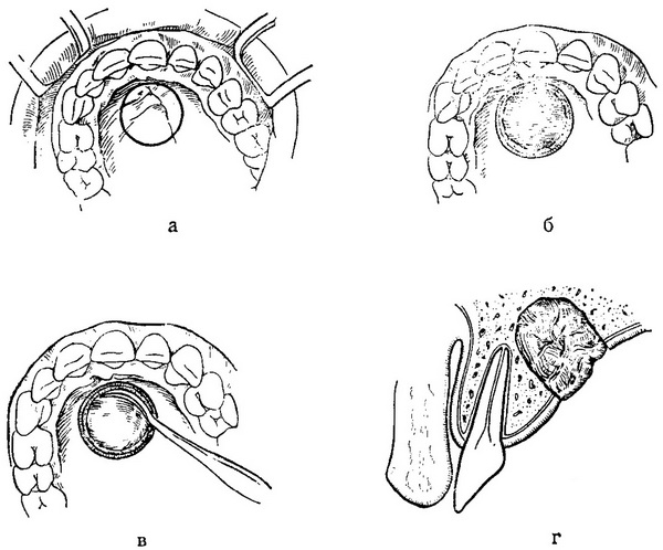 операція видалення кісти носонебного каналу