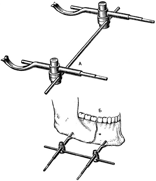 апарат Рудько для фіксації відламків нижньої щелепи