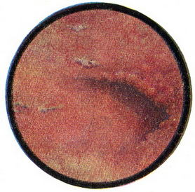 туберкульоз лівої нирки і сечоводу