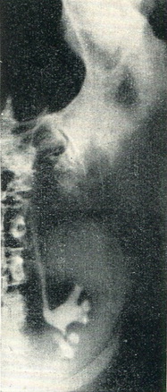 туберкульоз нирки