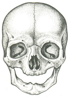 незарощення метопического шва у літньої людини