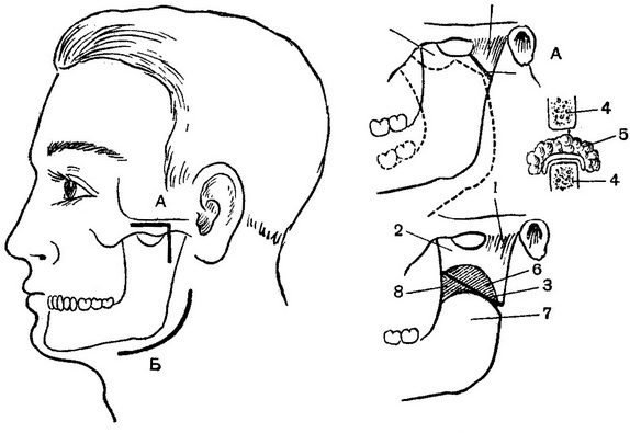 остеотомії при анкілозі суглоба