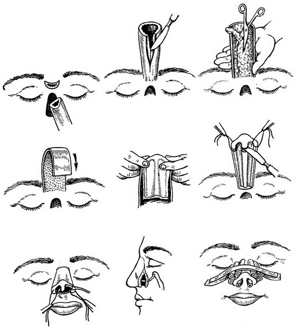 етапи формування носа по Ф. М. Хитрову