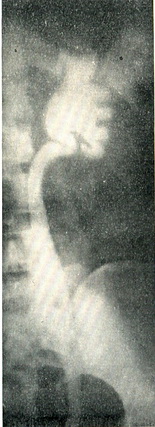 туберкульоз нирки і сечоводу