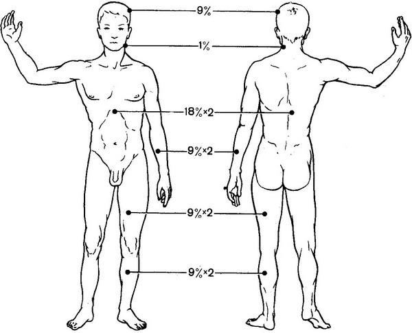 визначення площі опіків