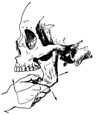 вправлення вивиху нижньої щелепи