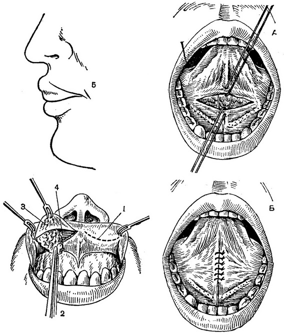 операція видалення подвійної верхньої губи