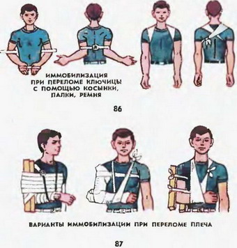 іммобілізація при переломі ключиці і плеча