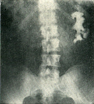 коралоподібні каміні лівої нирки