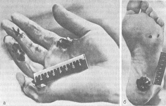 електрометкі