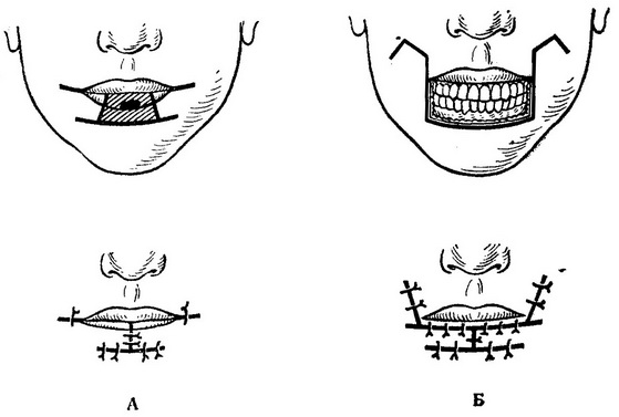 операція при раку нижньої губи