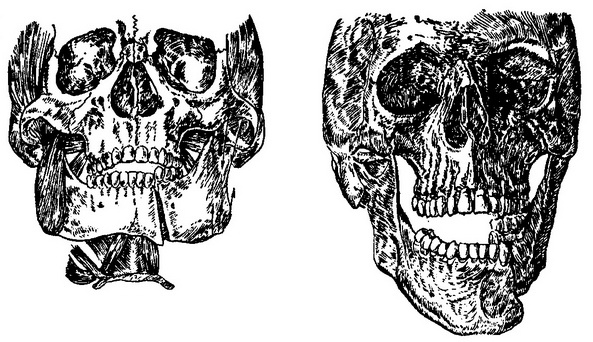 зміщення відламків при переломі нижньої щелепи