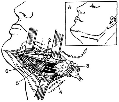 операція видалення підщелепної слинної залози