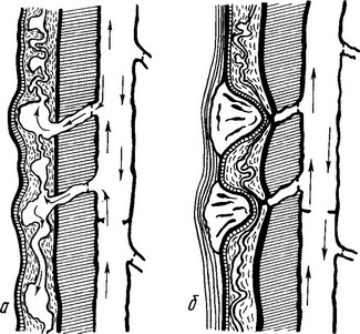 здавлення гирла перфораційних вен