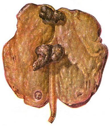 камені і жирове заміщення нирки