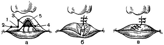 операція при частковій однобічній ущелині верхньої губи по А. А. Лімбергом