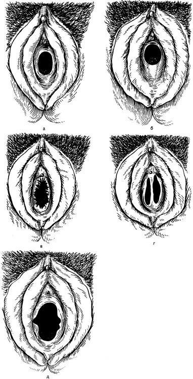 дівоча пліва