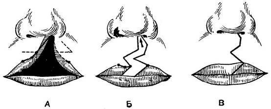 операція при повній ущелині верхньої губи за Лімбергом - Обухової