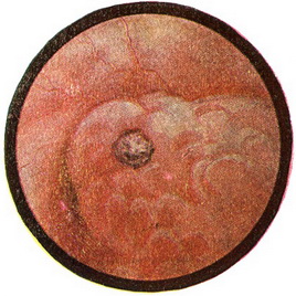 камінь в гирлі лівого сечоводу