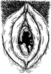 дефлорированная дівоча пліва