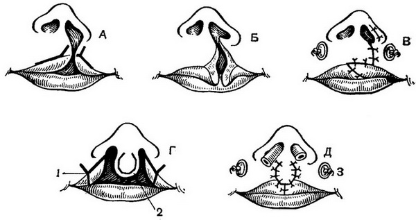 операція при ущелині верхньої губи по Євдокимову