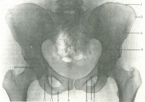 рентгенограма тазових кісток
