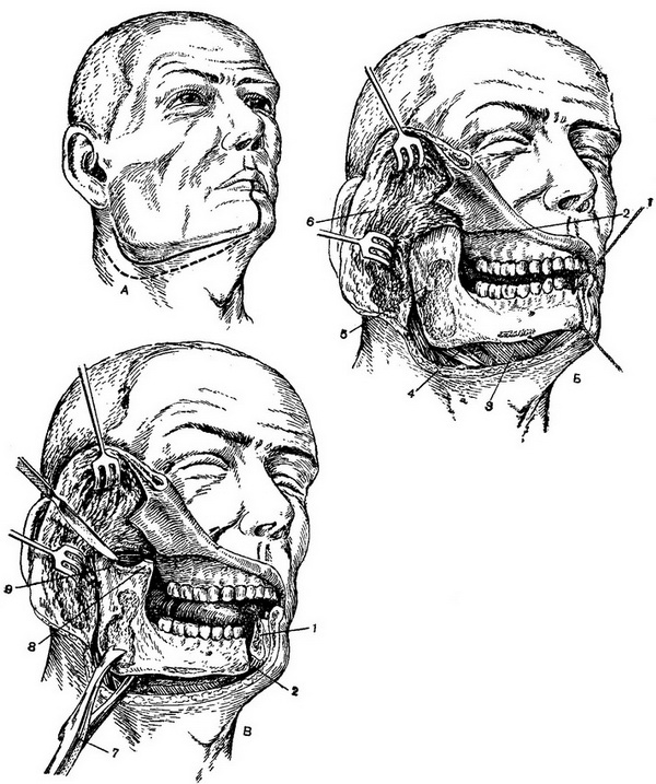 етапи резекції нижньої щелепи