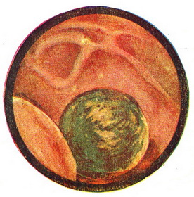 камінь сечового міхура - урат цистоскопія