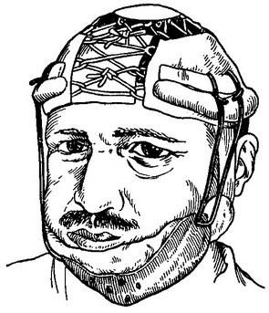 прикріплення жорсткої підборідної пращі до опорної головний пов'язці за Энтину