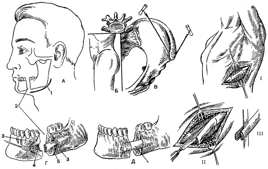 схема операції по усуненню дефекту нижньої щелепи