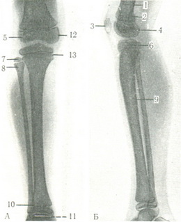 знімки кісток правої гомілки